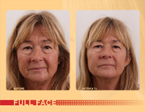 Exelis Facial Rejuvenation - New Jersey Exelis Facial Rejuvenation - New Jersey