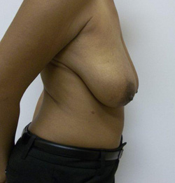 Before Breast Lift