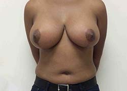 After Breast Lift