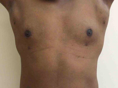 After Male Breast Reduction