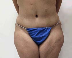 After Tummy Tuck