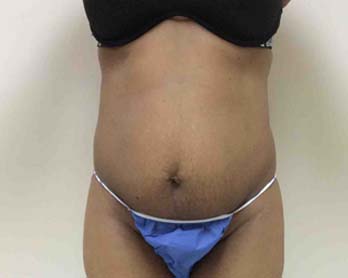 Before Tummy Tuck