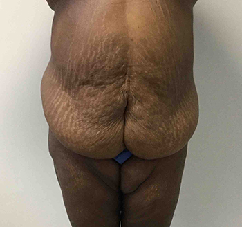 Before Tummy Tuck